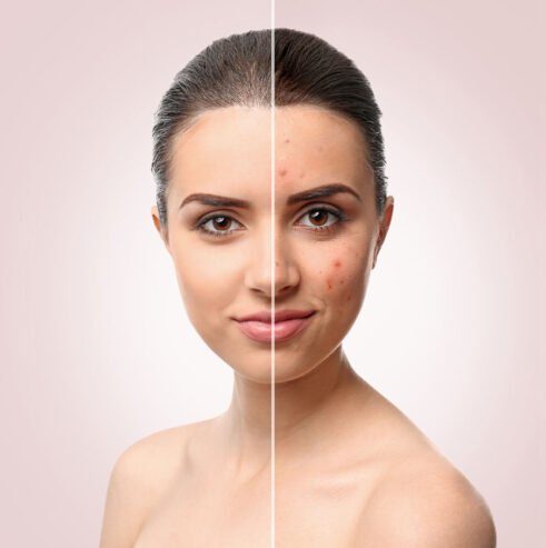 acne-before-after