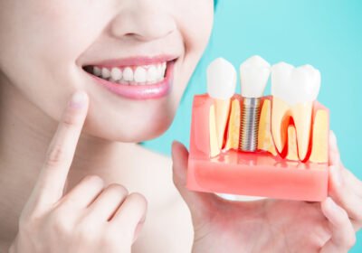 dental-implants-2020-01-13-5e1c497595a66