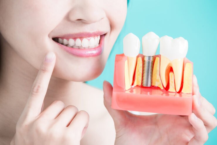Dental Implant Treatment in Delhi