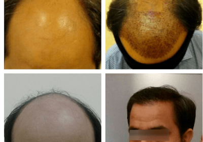 Hair Transplant Clinic in Gurgaon