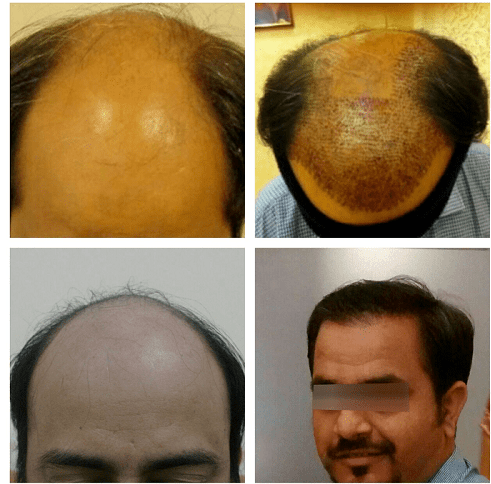 Hair Transplant Clinic in Gurgaon