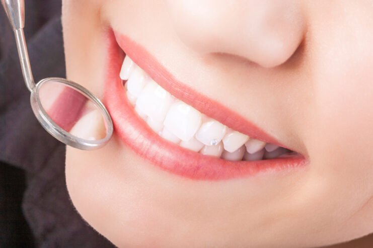 Dental Tooth Colored Composite Fillings in Delhi India.