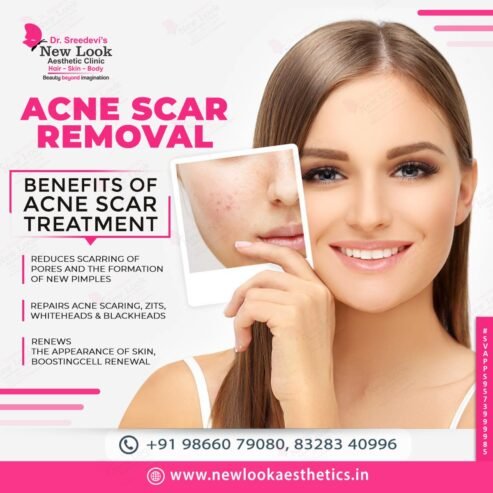 Acne-Scars-Treatment-in-Hanamkonda