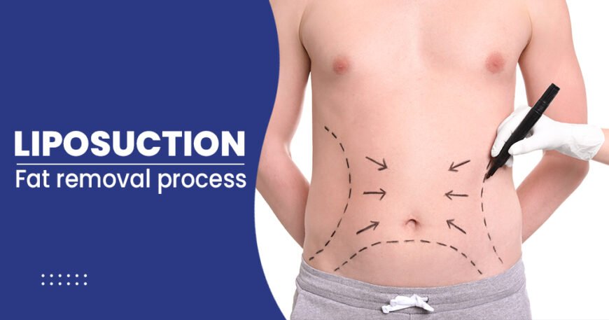 Liposuction cost in New Delhi, India