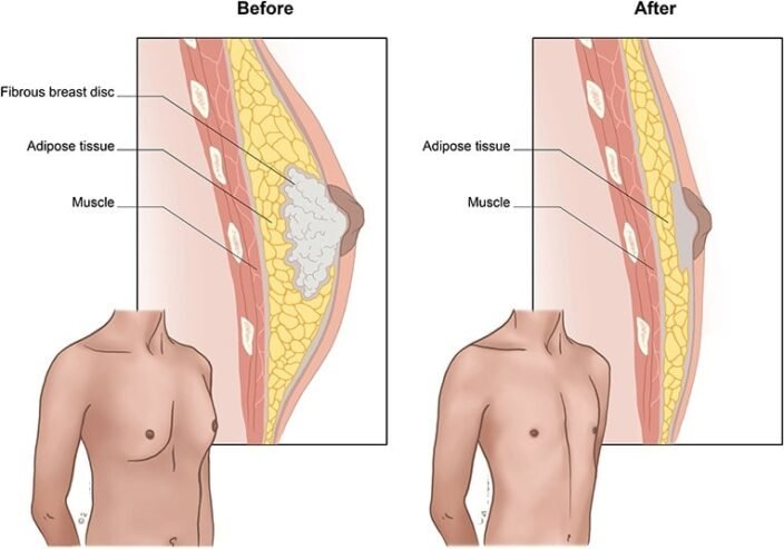 gynecomastia surgery treatment cost in india