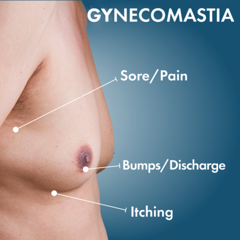 Best Gynecomastia surgery Hospital in Delhi