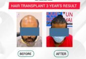 Best Hair Transplant Clinic In Tamilnadu