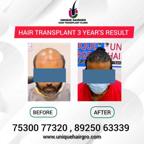 Best Hair Transplant Clinic In Tamilnadu