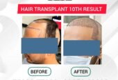 Best Hair Transplant Clinic In Tamilnadu