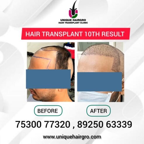 Best Hair Transplant Clinic In Tamilnadu